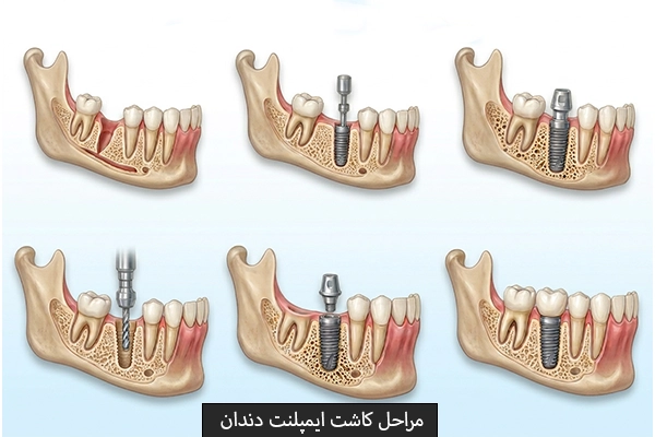مراحل کاشت ایمپلنت دندان