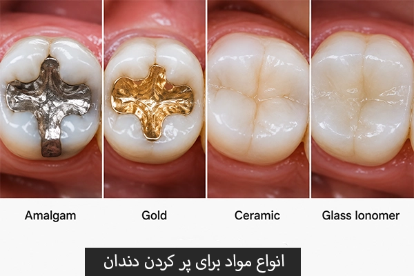 انواع مواد برای پر کردن دندان
