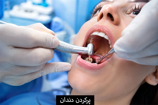 پر کردن دندان