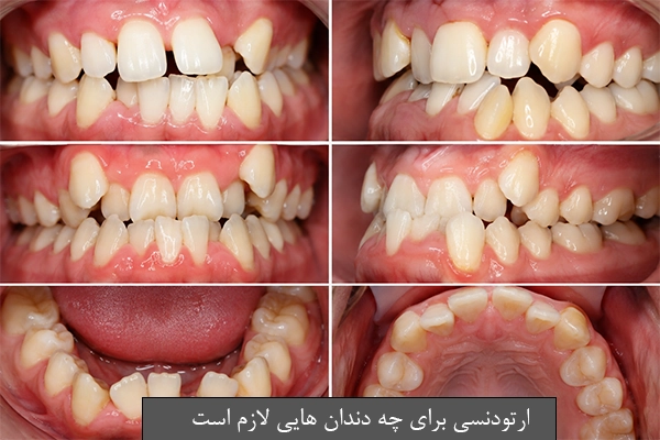ارتودنسی برای چه دندان هایی لازم است