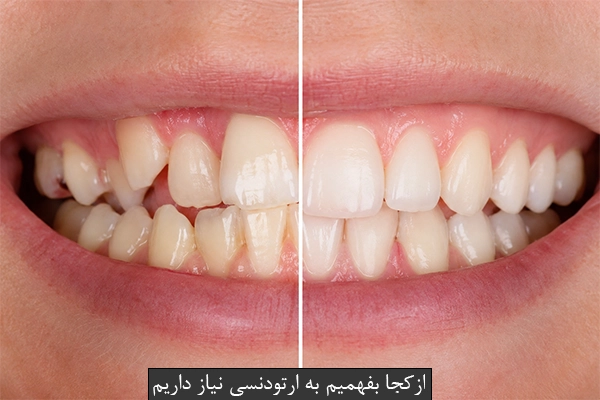 ازکجا بفهمیم به ارتودنسی نیاز داریم
