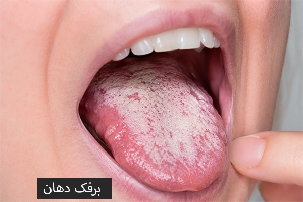 برفک دهان
