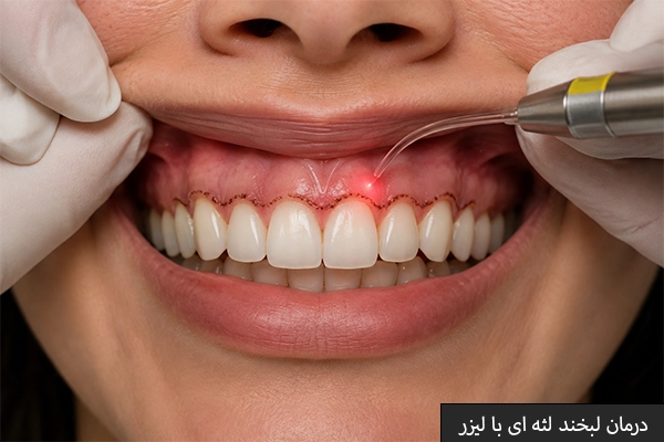 درمان لبخند لثه ای با لیزر