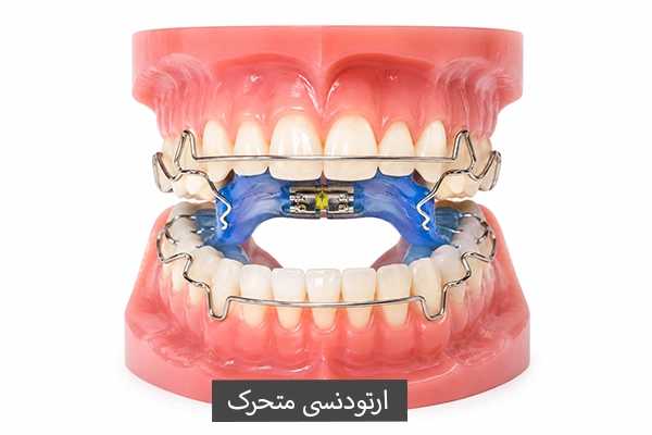 ارتودنسی متحرک