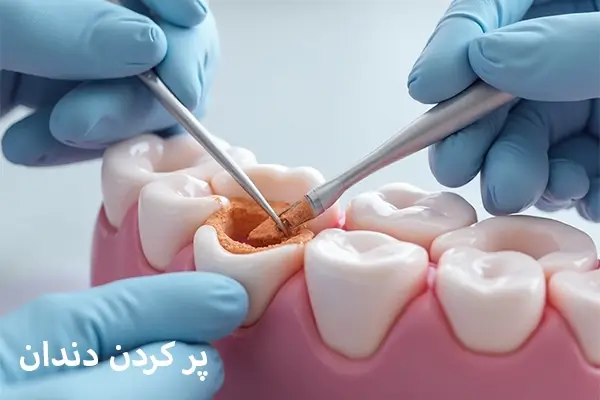 پرکردن دندان