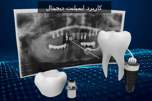 کاربرد ایمپلنت دیجیتال
