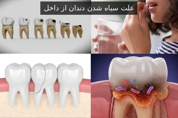 علت سیاه شدن دندان از داخل