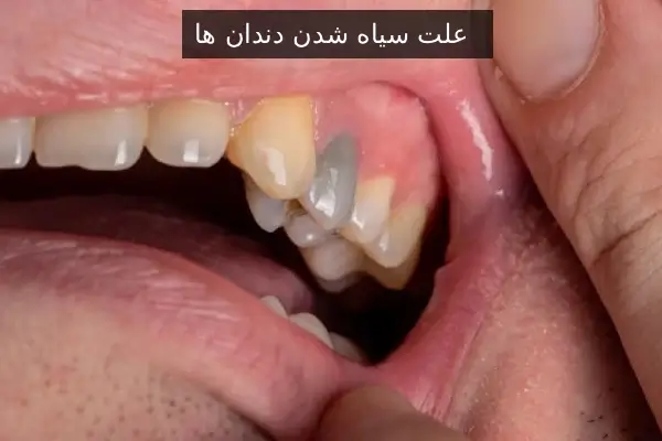 علت سیاه شدن دندان ها