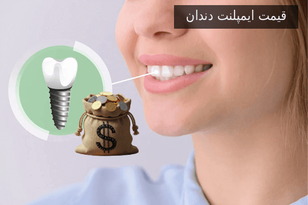 قیمت ایمپلنت دندان
