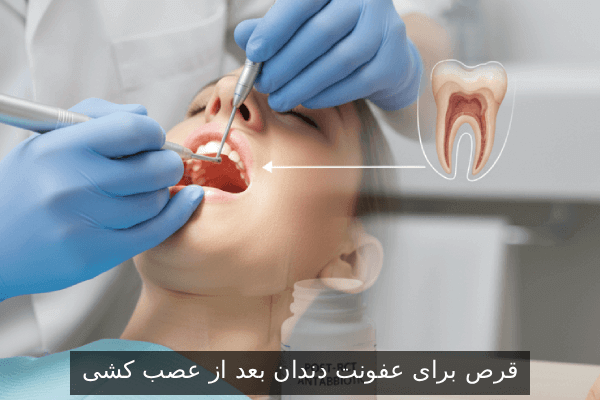 قرص برای عفونت دندان بعد از عصب کشی