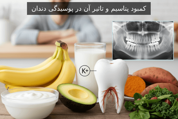 کمبود پتاسیم و تاثیر آن در پوسیدگی دندان
