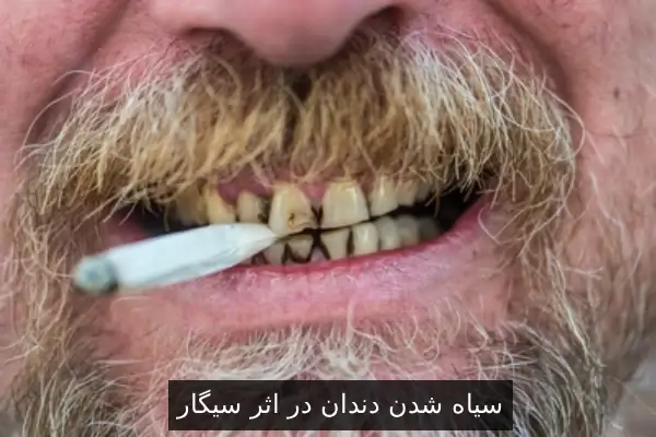 سیاه شدن دندان در اثر سیگار