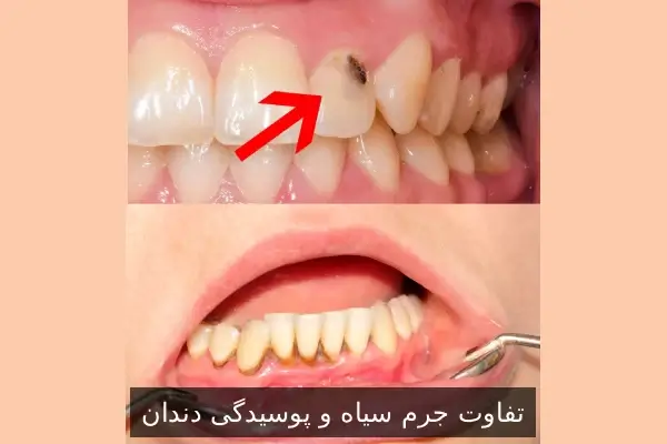 تفاوت جرم سیاه و پوسیدگی دندان