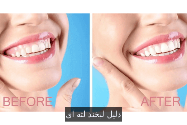 لبخند لثه ای