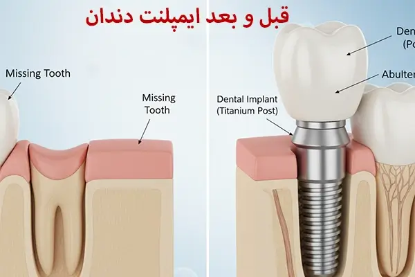 ایمپلنت دندان عکس قبل و بعد