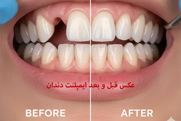 عکس قبل و بعد ایمپلنت دندان