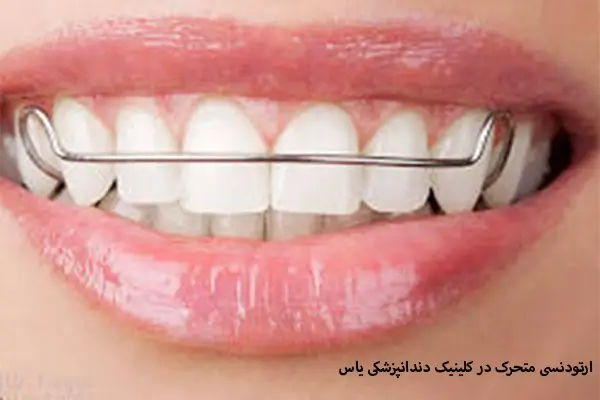 ارتودنسی متحرک در کلینیک دندانپزشکی یاس