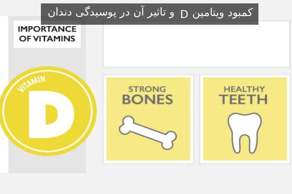 کمبود ویتامین D و تاثیر آن در پوسیدگی دندان