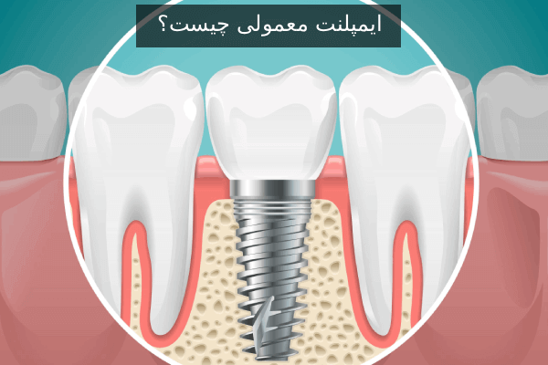 ایمپلنت معمولی چیست؟