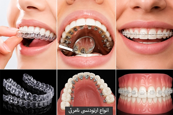 انواع ارتودنسی نامرئی