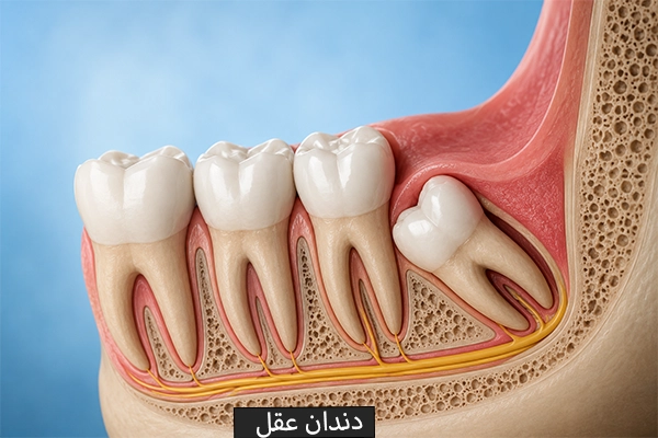 دندان عقل
