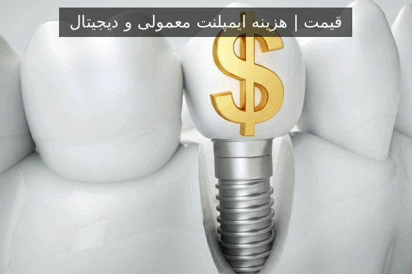 قیمت | هزینه ایمپلنت معمولی و دیجیتال 