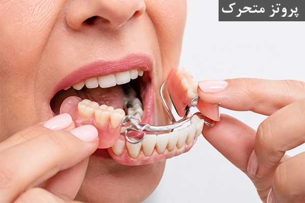 پروتز متحرک