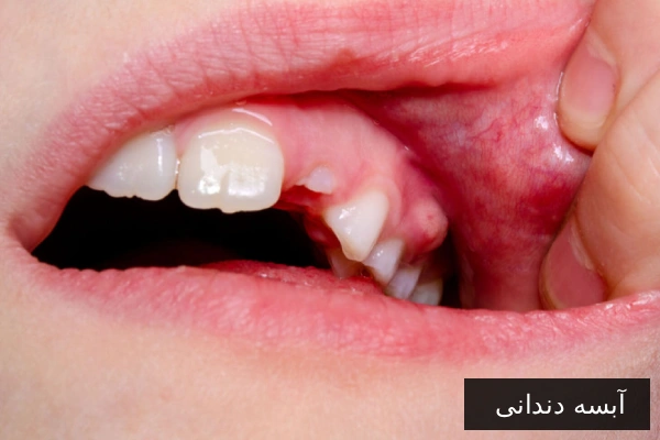 آبسه دندانی